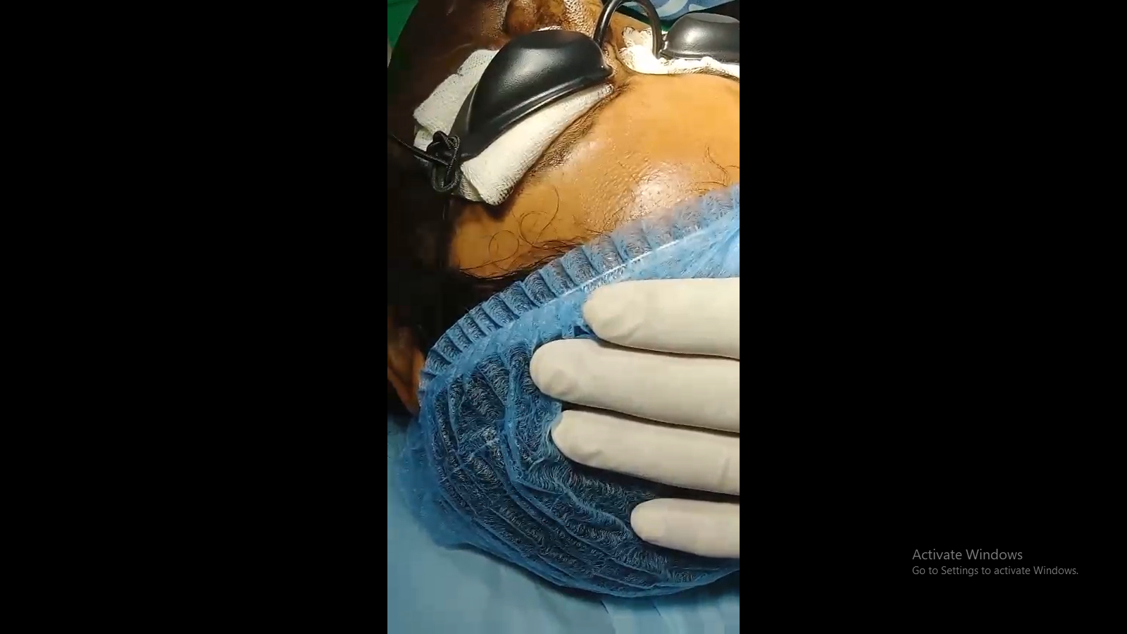Acne Scar Treatment